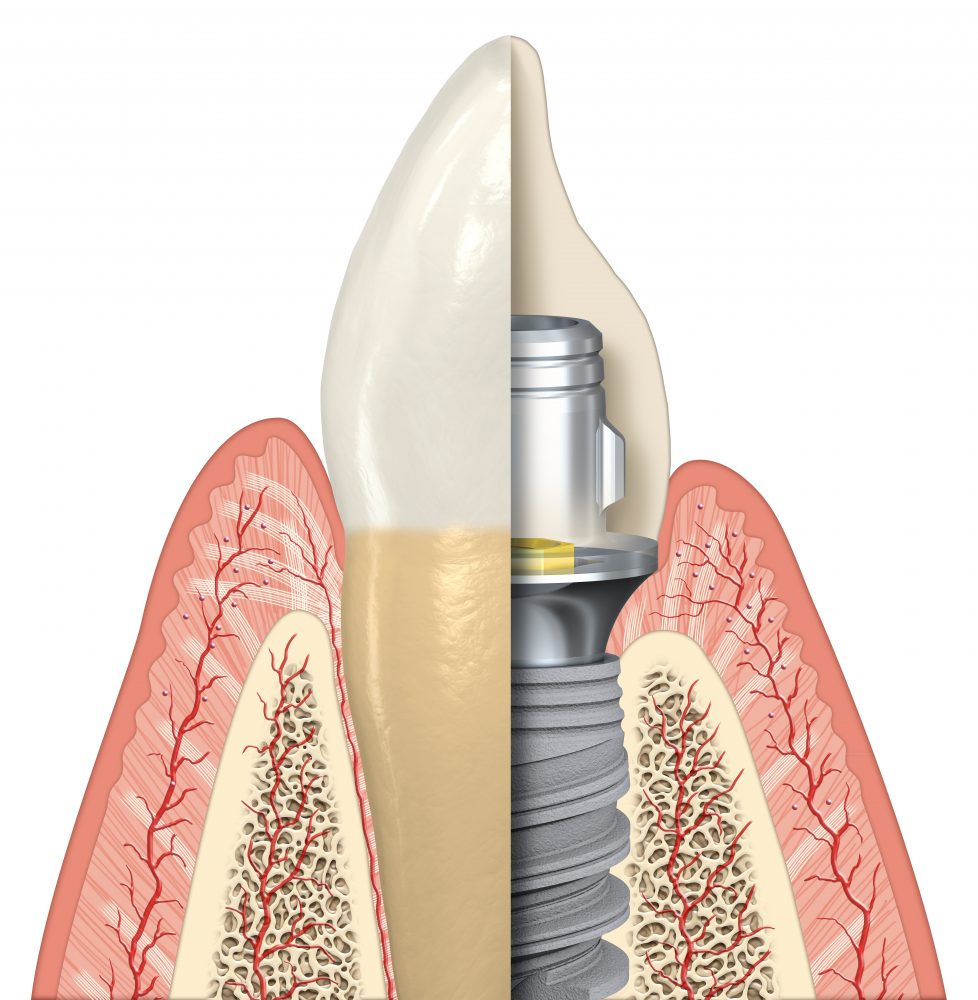 Vorteil einer frühen Implantation nach einem Zahnverlust: Perfekte Wiederherstellung von Funktion und Ästhetik