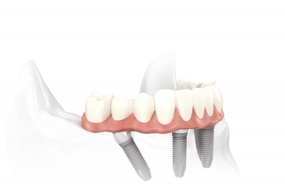 Bedingt herausnehmbarer, verschraubter Zahnersatz auf 4 Implantaten im Unterkiefer.