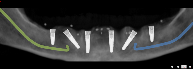 All-on-6 – Behandlungskonzept