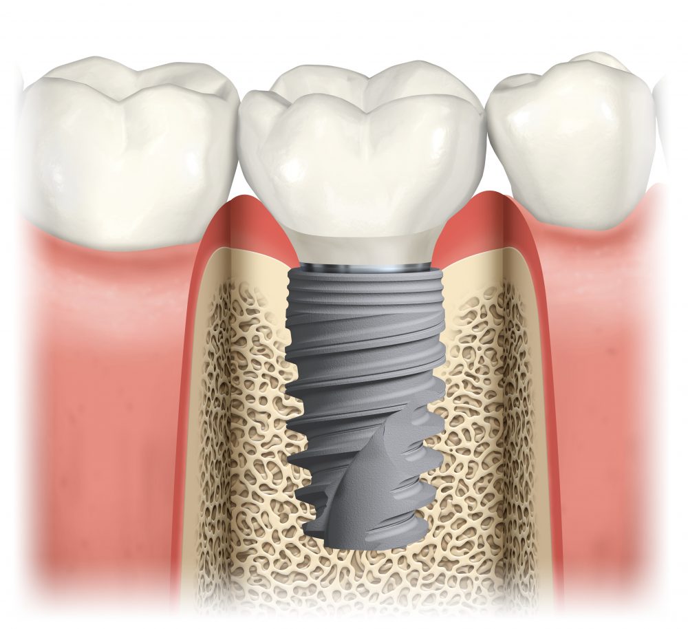 Behandlungsablauf Zahnimplantat: Vollkeramikkrone auf Titanschraube im Unterkiefer