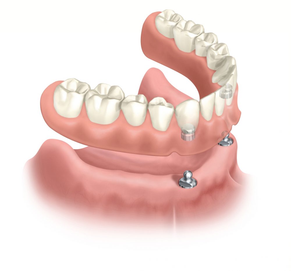 Ohne gaumenplatte zahnprothese Bester Zahnersatz