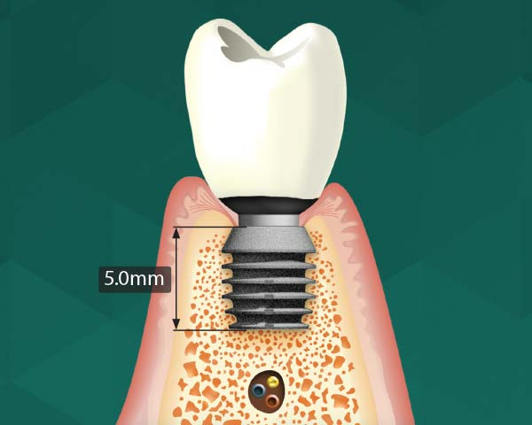 Kurze Implantate: Knochenaufbau vermeiden.