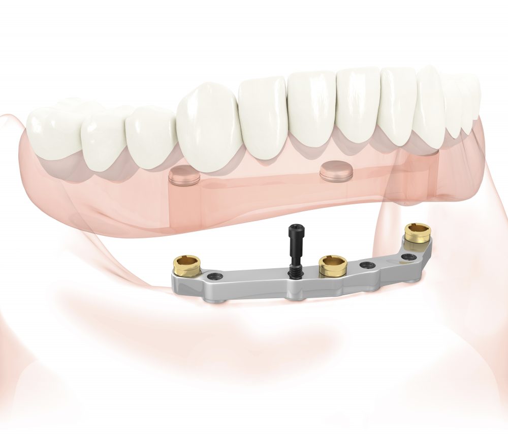 Stegprothese als herausnehmbarer Zahnersatz auf 4 Implantaten im Unterkiefer