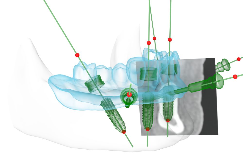 3D-Implantatplanung für optimalen Zahnersatz auf 4 Implantaten: All-on-4 Konzept™