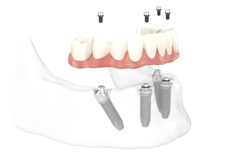 Zahn erfahrung implantat Welche Erfahrungen