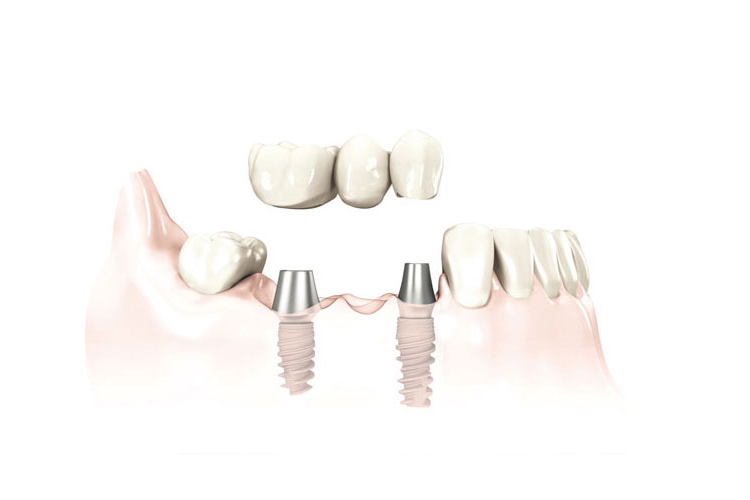 implant24.com – Zahnersatz implant24.com - Zahnersatz