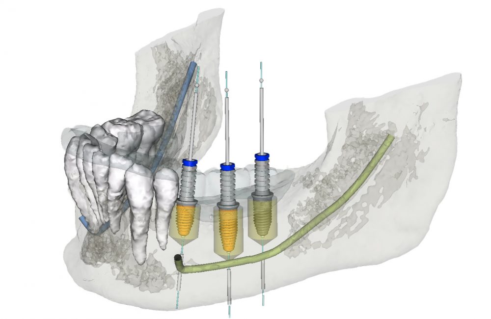 Computergestützter 3D Implantatplanung
